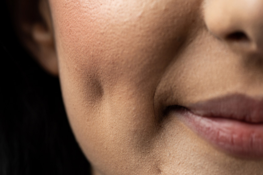 روز چال گونه. منبع عکس: وبسایت Shinmedical.Com. عکاس: نامشخص